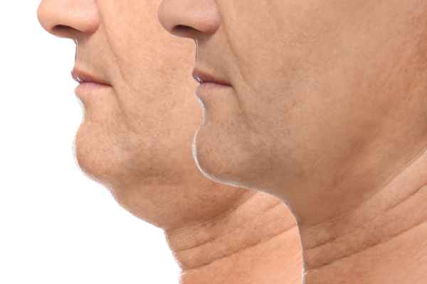 HIFU - Breakthrough in Anti - ageing 2 hifu results Blackheath