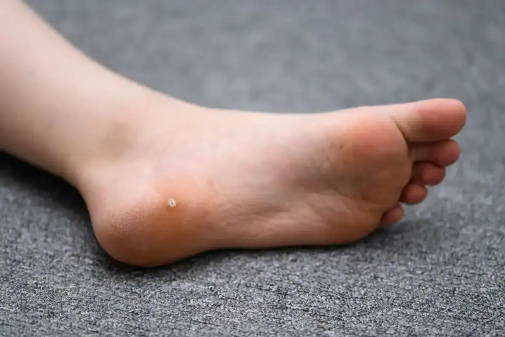 Cryotherapy For Warts And Also Verrucas 2 Image of verruca on the bottom of the foot that able to be treated with Cryotherapy Blackheath