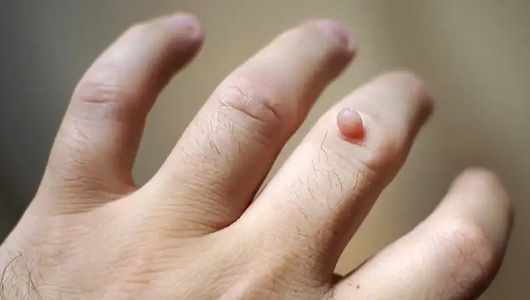 Cryotherapy For Warts And Also Verrucas 1 Image of blemish that Cryotherapy Blackheath can remove with Lipo 360.