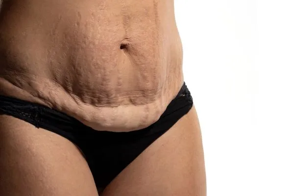 The Science of Skin Tightening 1 The science behind skin tightening Blackheath picture of a woman's sagging skin on the stomach